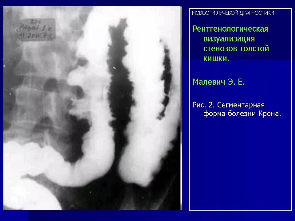 Стеноз кишечника что это. Сужение толстой кишки рентген. Болезни на рентгене толстой кишки. Болезнь крона тонкой кишки рентген. Болезнь крона ирригоскопия.