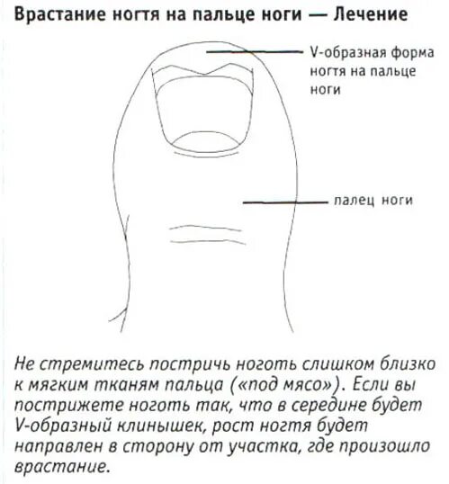 Как подстригать ноготь большого пальца ноги. Как правильно стричь ногти на ногах. Как правильно стричь вросший ноготь.