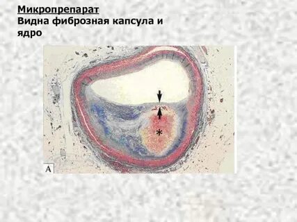 Фиброзная капсула