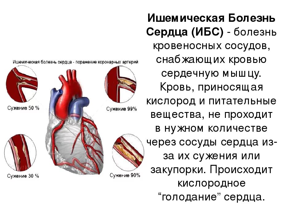 Коронарная ишемия. Сосуды сердца. Ишемическая болезнь сердца. Заболевания коронарных сосудов. Сосудистые заболевания сердца.