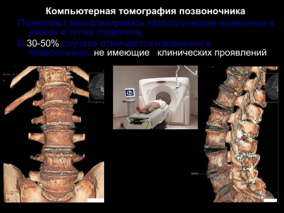 Кт позвоночника. Спиральная кт позвоночника. Компьютерная томография позвоночника. Компьютерная томография (кт) позвоночника. Можно делать кт позвоночника