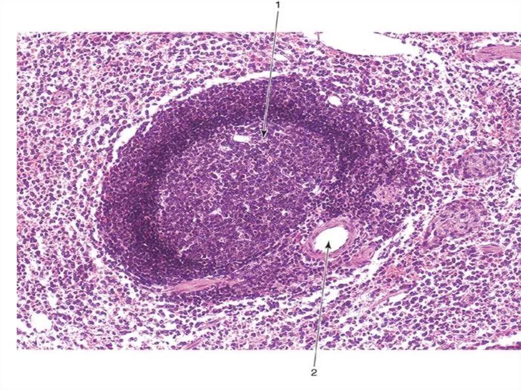 Селезенка гистология препарат. Красная пульпа селезенки гистология. Септическая гиперплазия селезенки микропрепарат. Селезенка гистопрепарат. Распад селезенки