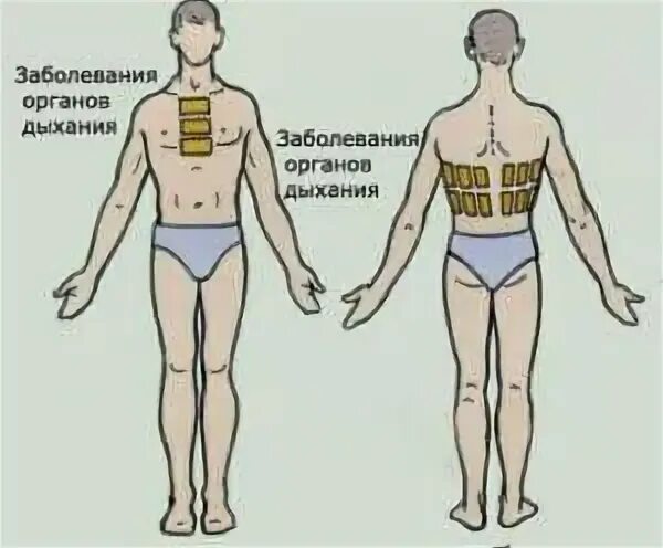 Сколько держать горчичники на спине. Горчичники на спину при кашле. Места постановки горчичников. Как ставить горчичники. Места постановки горчичников при бронхите.