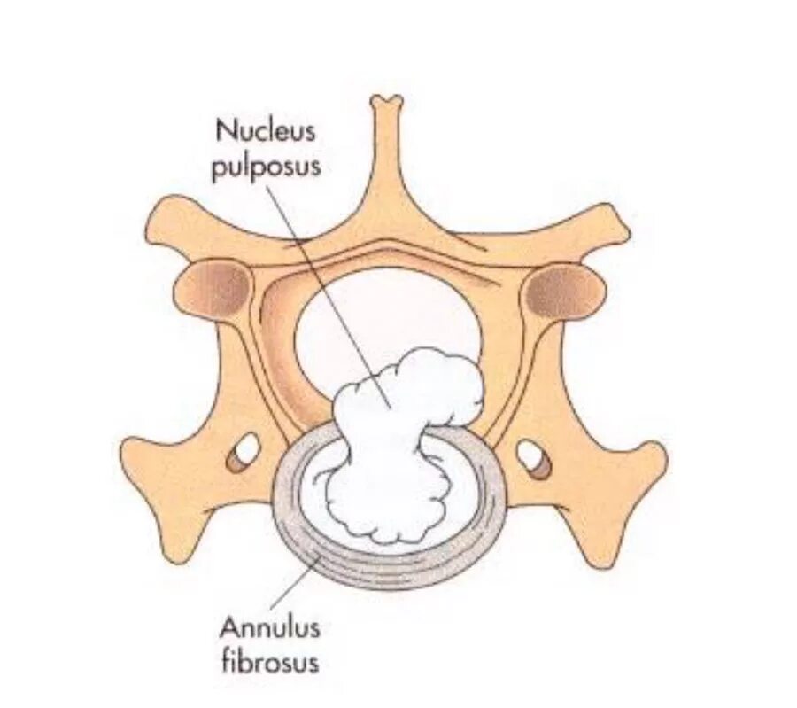 Межпозвоночные диски (Discus intervertebralis):. Нуклеус пульпосус. Anulus fibrosus. Nucleus pulposus annulus fibrosus. Экструзия дисков шейного отдела позвоночника