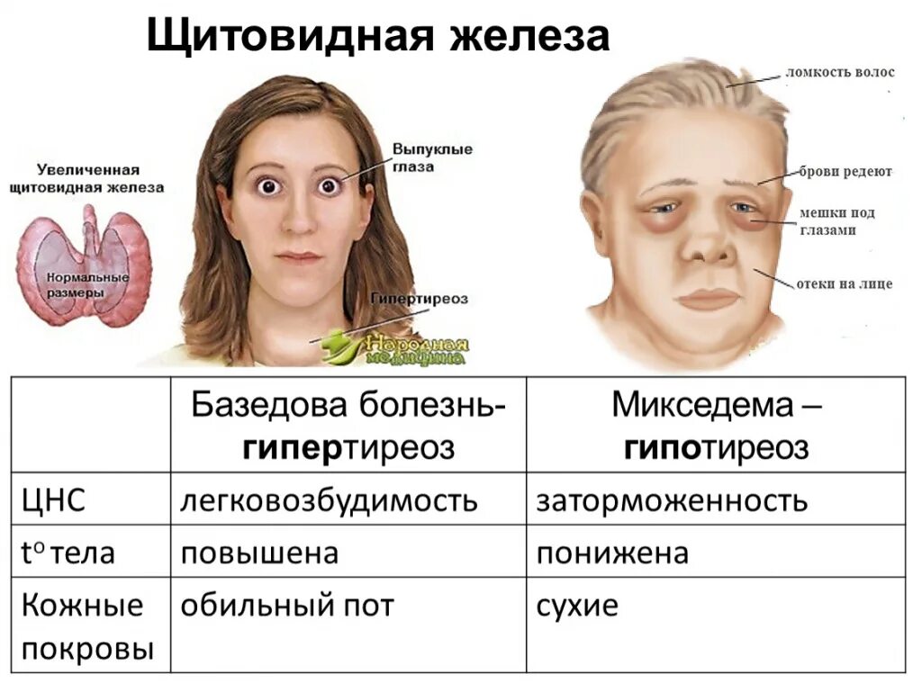 Жить какое лицо. Болезни щитовидной железы. Заболевание щитовиднойжелезв. Болезни связанные с щитовидной железой. Нарушение щитовидной жел.