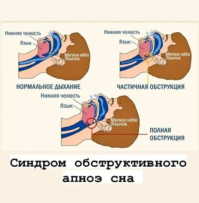 Ночью человек задыхается. Синдром обструктивного апноэ сна. Синдром остановки дыхания у младенцев. Синдром обструктивного сонного апноэ. Синдром обструктивного апноэ сна у ребенка.