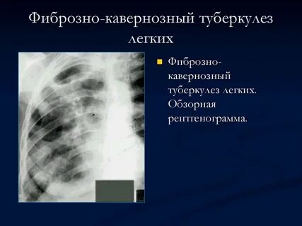 Лечение кавернозного туберкулеза легких