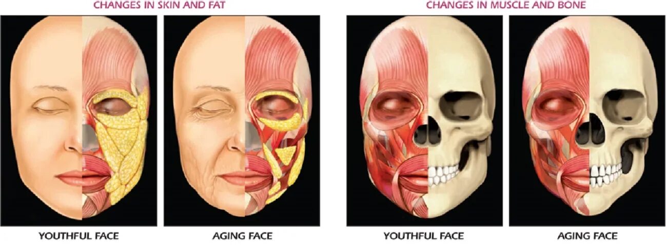 Основным признаком возрастных изменений костей. Резорбция костной ткани черепа. Возрастные изменения мышц лица. Возрастные изменения черепа.