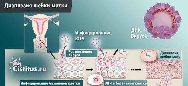 Вирус рака шейки матки. Дисплазия шейки матки HPV. Цервикальная интраэпителиальная неоплазия и ВПЧ.