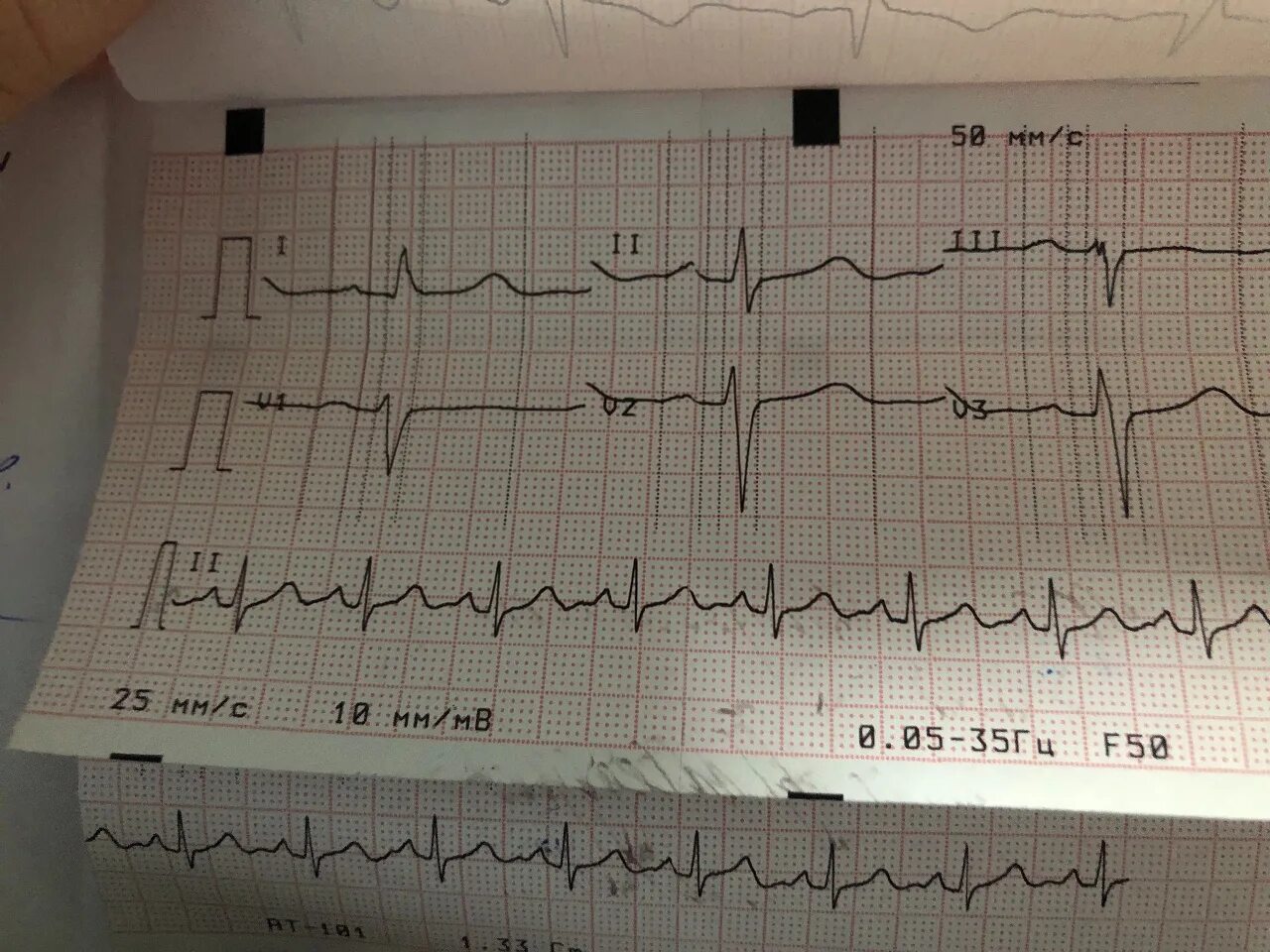 Экг сердца москва. ЭКГ кардиограмма сердца. Плохая кардиограмма. ЭКГ больного сердца. Кардиограмма сердца больного человека.