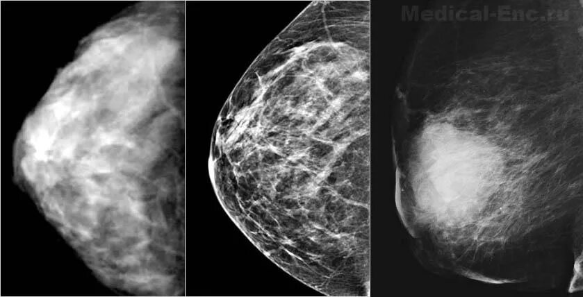 Маммография старый. Фиброаденоз маммография. Опухоль молочной железы маммограмма. Маммография рентген молочной железы. Рик молочной железы маммографич.