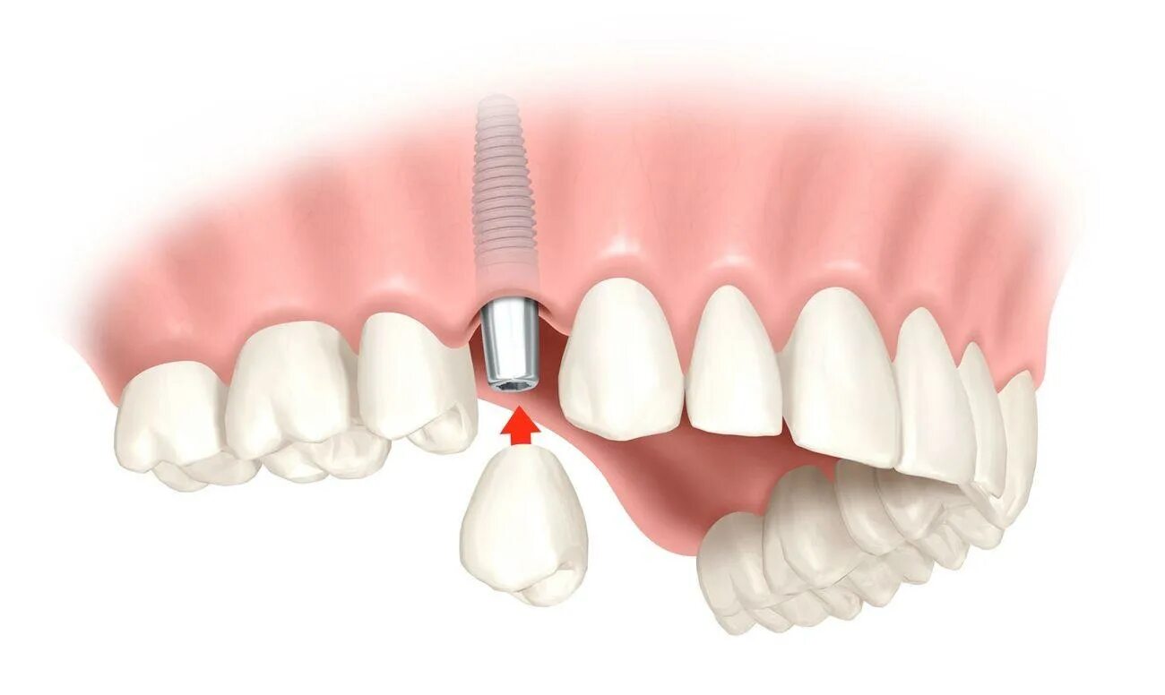 Классическая двухэтапная имплантация. Классическая двухэтапная имплантация зубов. Одноэтапная и двухэтапная имплантация. 3 зуба установить