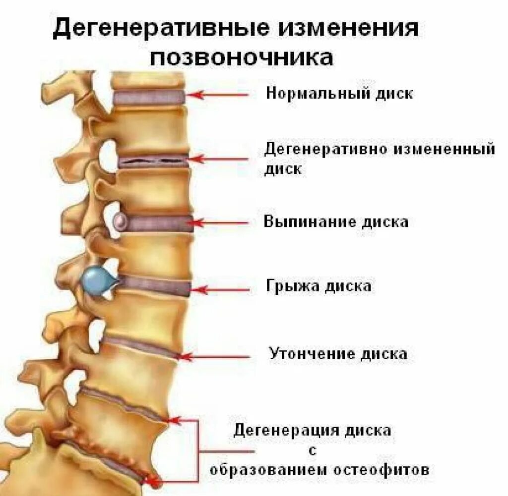 Спондилёз поясничного отдела позвоночника что это такое. Межпозвонковый спондилоартроз с7-th1. Остеохондроз спондилоартроз поясничного отдела позвоночника. Спондилоартроз межпозвонковых дисков поясничного отдела. Остеохондроз с7