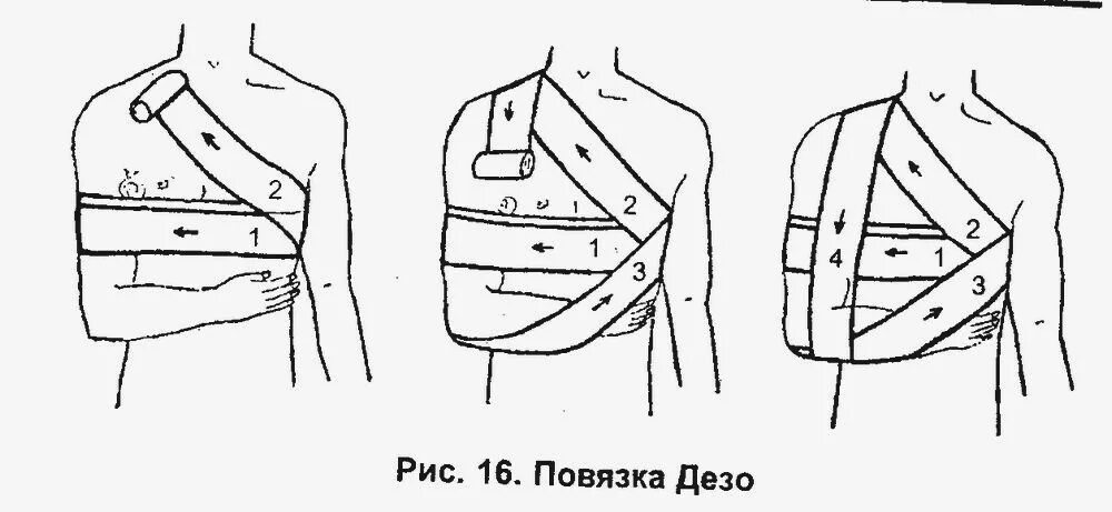 Дезо бинтование. Повязка Дезо показания к наложению. Повязка Дезо на плечевой сустав бинтом алгоритм. Дезо повязка алгоритм показания.