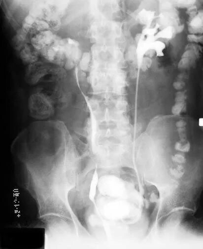 Рентген мочеточника. Стриктура н/3 мочеточника. Стент в мочеточнике рентген. Ретроградная урография. Рентген почек с камнями мочеточника.