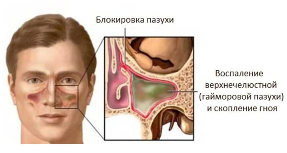 Прокол гайморита верхнечелюстной пазухи. Пункция челюстной пазухи. Воспалительный процесс в околоносовых пазухах. Симптомы гайморита у взрослых без температуры признаки