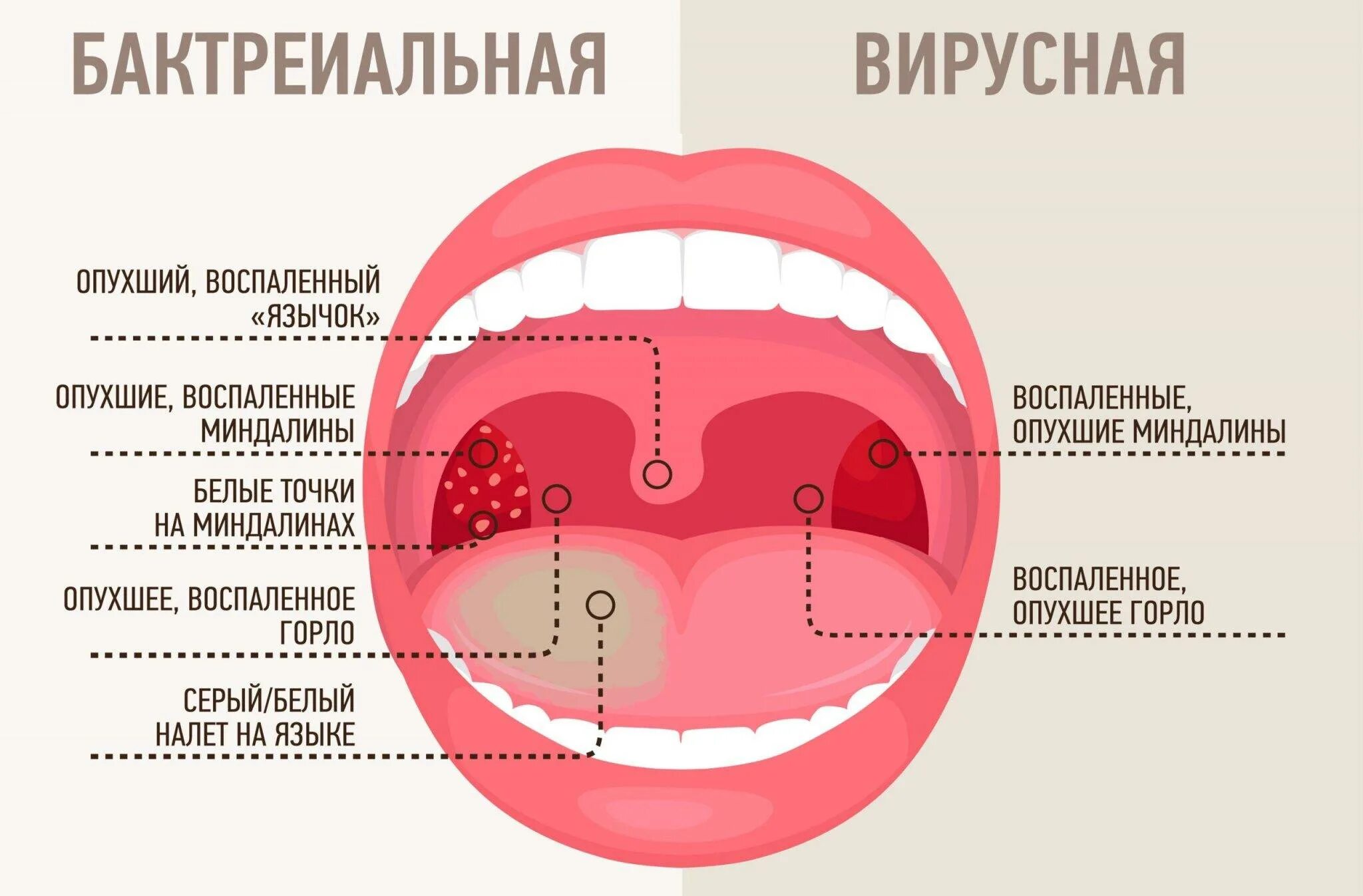 Сколько при ангине держится температура у взрослого. Вирусная и бактериальная ангина. Горло при вирусной инфекции.