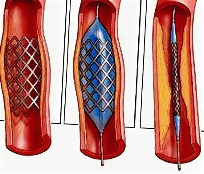 Ангиопластика сосудов нижних конечностей. Баллонная ангиопластика артерий нижних конечностей ход операции. Стентирование сосудов нижних конечностей. Стентирование атеросклерозе артерий конечностей. Операция на сосудах нижних конечностей