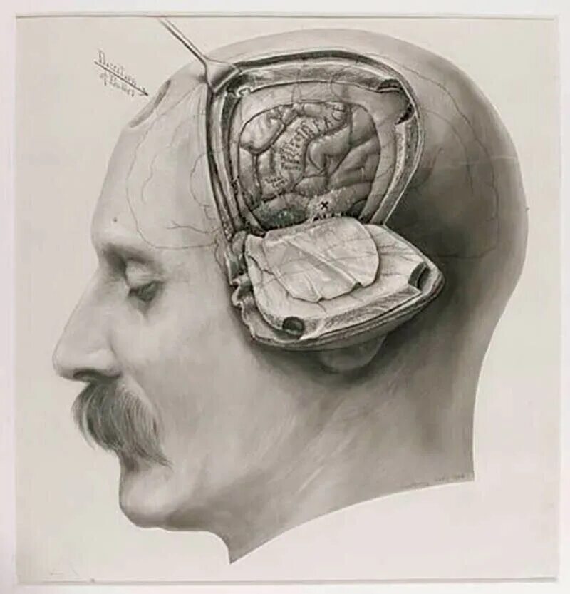 Трепанация черепа анатомичка. Вскрытие черепа человека. Человеческий мозг в черепе. Лоботомия геометрия