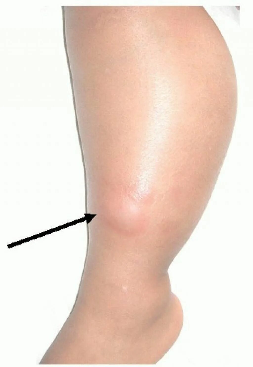 рожистое воспаление правой голени. опухают икры ног что делать. слайдер длины ноги. опухают икры ног что делать. икра крупная.