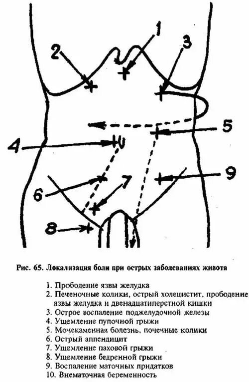 Болит полость живота. 12перстная кишка при пальпации живота. Болевые точки при заболеваниях органов брюшной полости. Болевые точки при заболеваниях ЖКТ схема. Болевые точки при патологии органов брюшной полости.