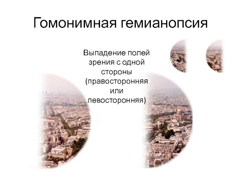 Гомонимная гемианопсия поражение. Гомонимная контрлатеральная гемианопсия. Гомонимная гемианопсия поражение. Квадрантная гомонимная гемианопсия. Гомонимная гемианопсия поражение.
