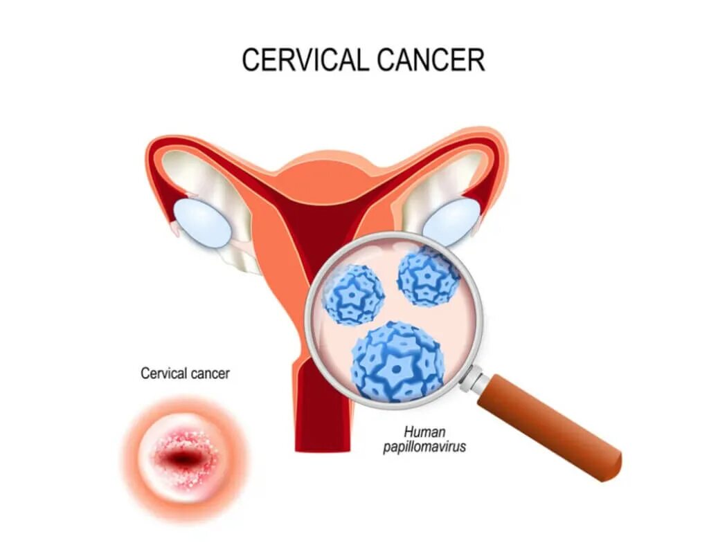 Впч и рак шейки. Раковые шейки конфеты cervical cancer. cancer close.