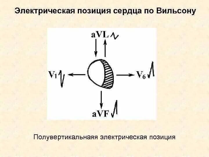 Вертикальная позиция сердца. Электрическая позиция сердца. Электрическая позиция по Вильсону. Электрическая позиция сердца по Вильсону. Электрическая позиция по Вильсону ЭКГ.