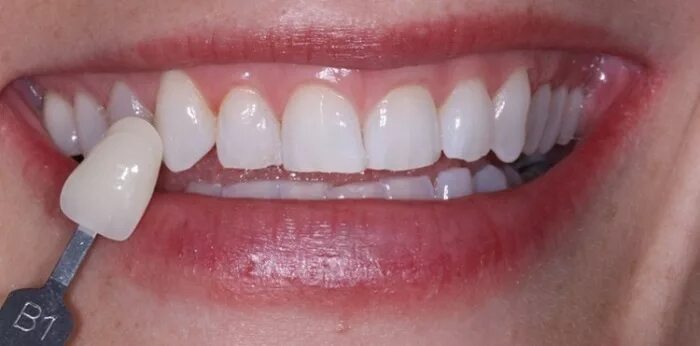 керамические виниры цвет блич 2. керамические виниры блич 2. цвет блич 2.