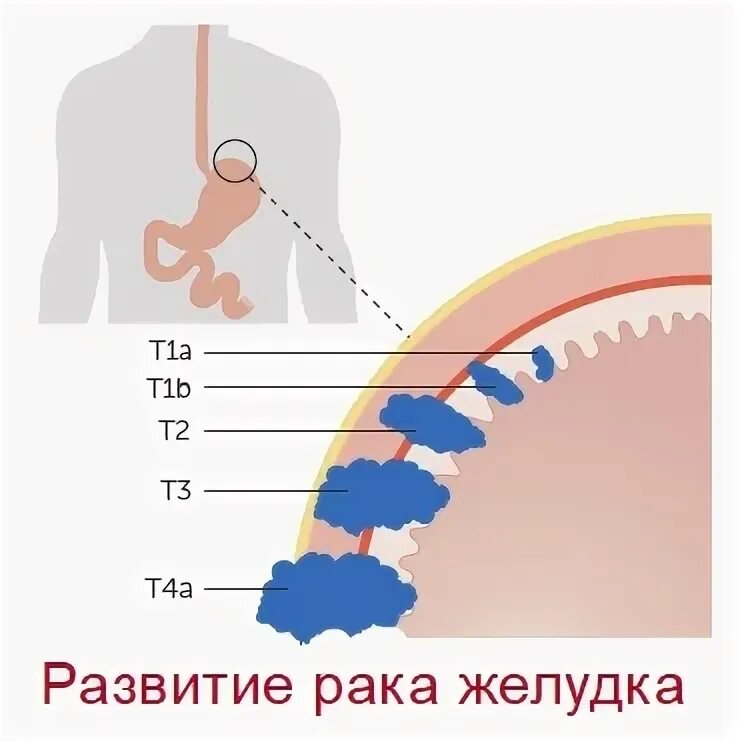 Стадия опухолевого процесса 4. Термальная стадия онкология что это. Карцинома желудка 4 стадии прогноз. Онкология желудка 4 стадия