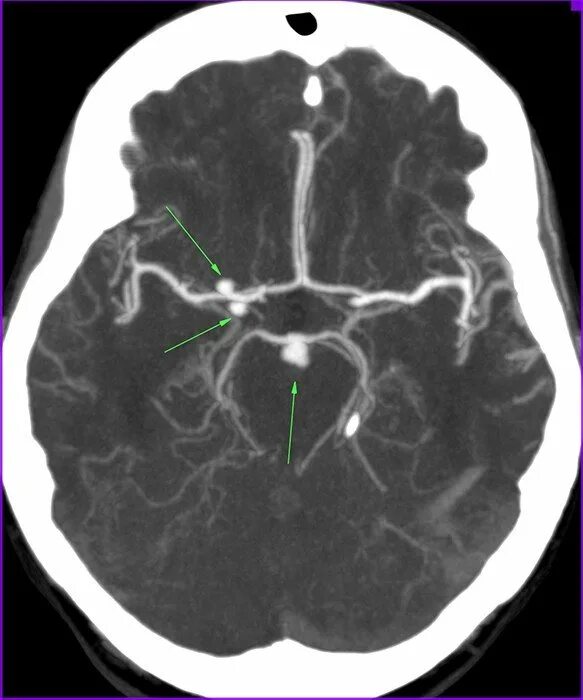 Сосуды головного мозга норма. Кт ангиография аневризма головного мозга. СКТ-ангиография сосудов головного мозга. Аневризма сосудов головного мозга кт ангиография. Кт венография головного мозга.