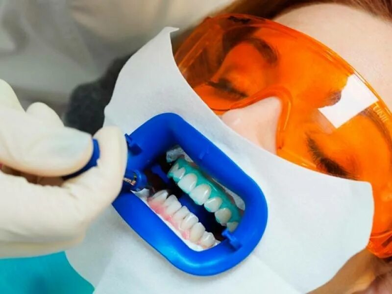 Зоом отбеливание зубов. Отбеливание зубов в стоматологии. Отбеливание зубов amazing White.