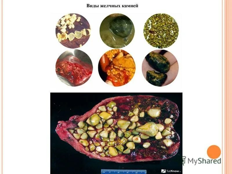 Камни желчь пузыря. Камни желчного пузыря патанатомия. Желчный пузырь патанатомия. Камни в желчном пузыре патологическая анатомия. Коралловидные конкременты желчного пузыря.