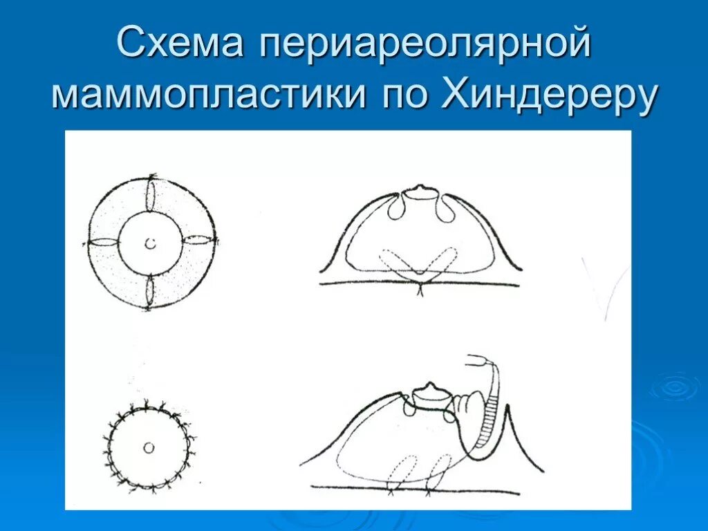 Периареолярная подтяжка. Периареолярная маммопластика. Редукционная маммопластика схема. Редукционная маммопластика схема операции. Подтяжка грудных желез периареолярная.