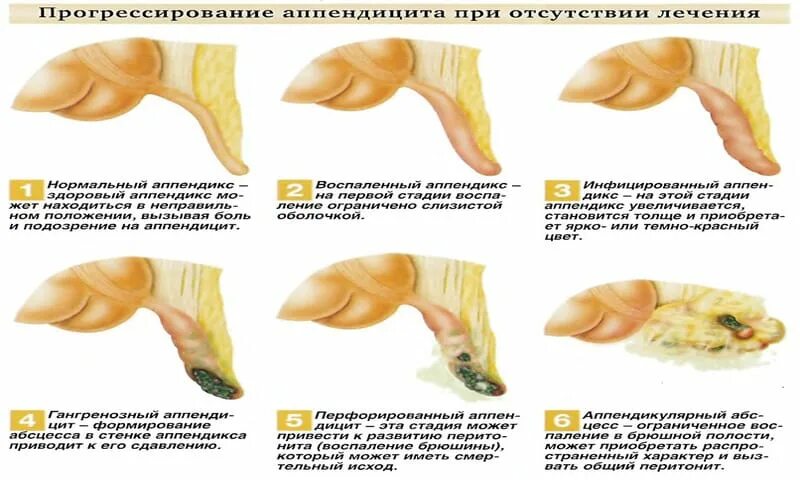 Ответы Mail.ru: Возможен ли у меня аппендицит?