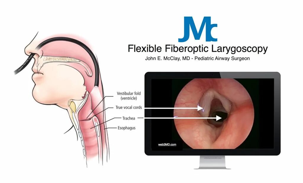 Пою на связках. Эпиглоттит надгортанник. Прямая и непрямая ларингоскопия. Голосовые складки ларингоскопия. Фиброларингоскопия надгортанник.