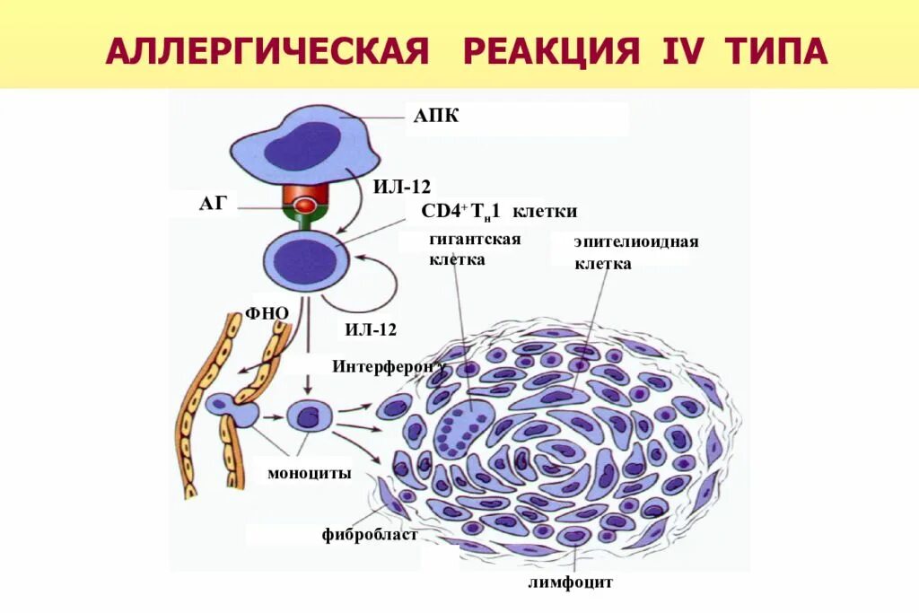 Схема гиперчувствительности 4 типа. Схема реакции гиперчувствительности 4 типа. Типы аллергических реакций 4 типа. Схема аллергической реакции 4 типа. Для аллергических реакций характерно