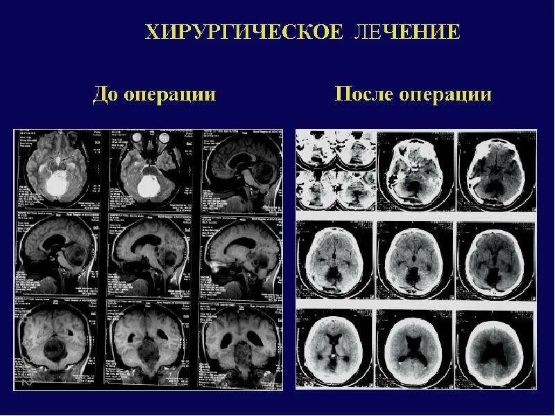 Объемное образование головного мозга код. Хирургия супратенториальных опухолей.. Супратенториальные кисты головного. Супратенториальные опухоли головного мозга презентация. .Опухоли гол.мозга супратенториальной локализации..