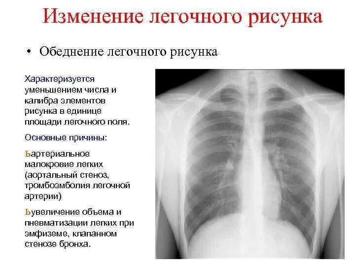 Что означает изменения в легких. Обеднение легочного рисунка на рентгене. Обеднение сосудистого рисунка легких. Изменение легочного рисунка. Обеднение легочного сосудистого рисунка.