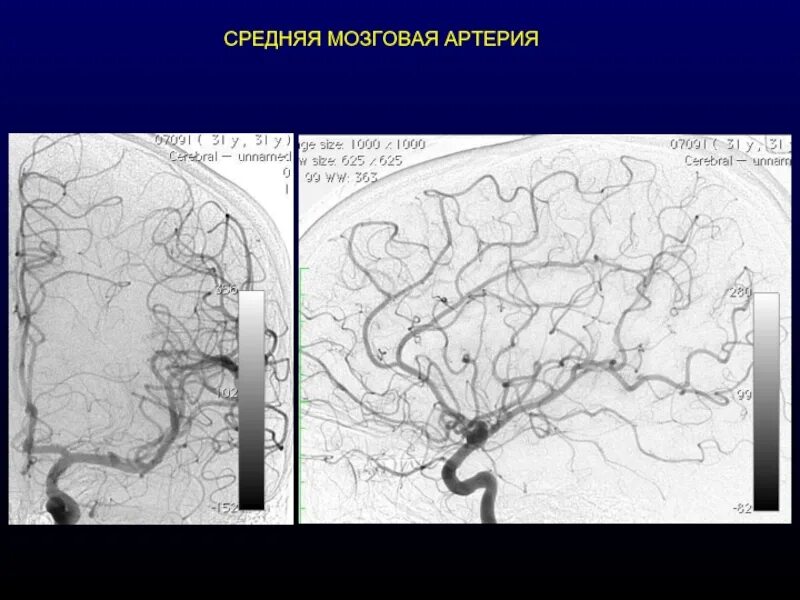 Сегменты средней артерии. Ветви средней мозговой артерии анатомия. корковые ветви средней мозговой артерии. поверхностные ветви средней мозговой артерии. средняя артерия головного мозга.