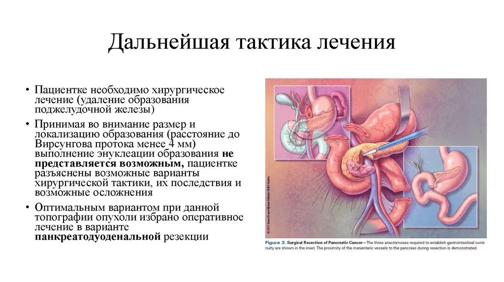 Для дальнейшего лечения. Гастропанкреатодуоденальную резекцию. Разбор клинического случая презентация. Как понять дальнейшем тактике лечения. Гастропанкреатодуоденальная резекция кал посветлел.