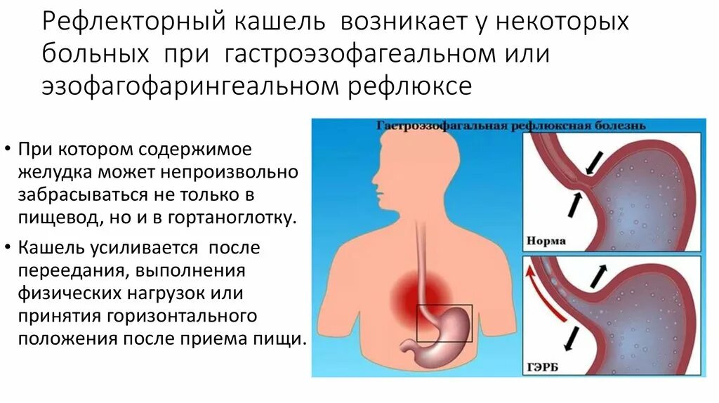 Температура пищевода. Рефлекторный кашель. ГЭРБ кашель. Кашель при Гастроэзофагеальная рефлюксная болезнь. Кашель при пищеводном рефлюксе.