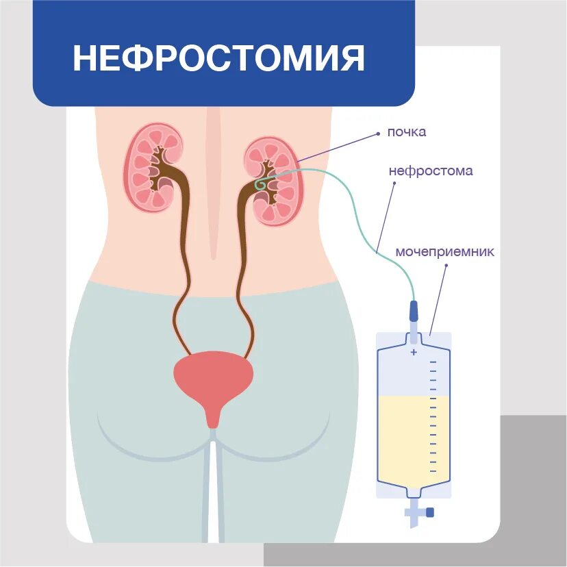 Несостоятельность нефростомы мкб