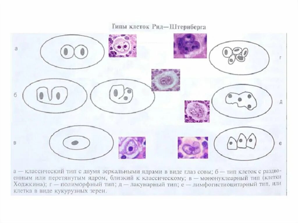 Рид штернберга. Клетки Рид-Березовского-Штернберга. Клетки Рида Березовского Штернберга. Клетки Рид Березовского. Клетки Рид Штернберга виды.
