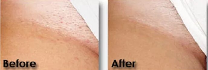 Зона бикини после лазерной эпиляции. Глубокое бикини до лазерная эпиляция. Бикини после лазерной эпиляции. Бикини пятна. Раздражение в зоне бикини.