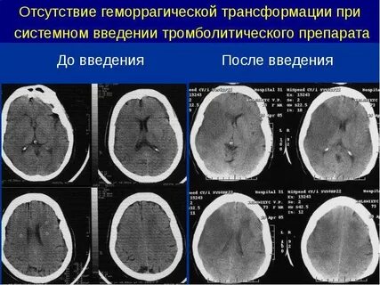 Геморрагическая трансформация ишемического инсульта