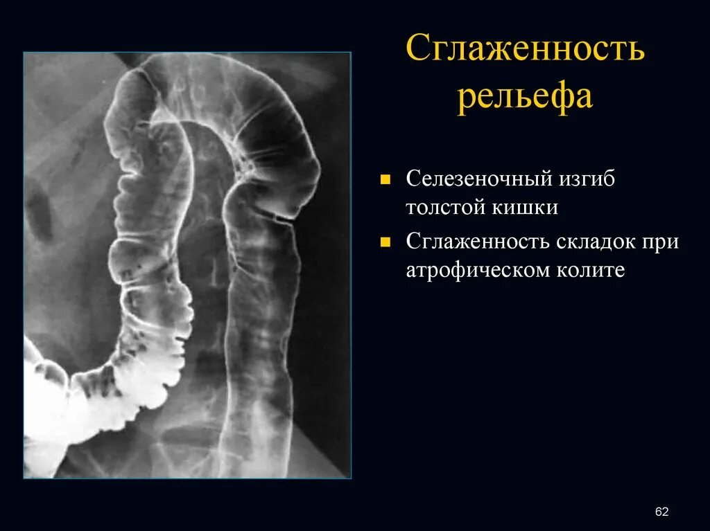 Селезеночный изгиб толстой кишки. Селезеночный угол толстой кишки. Селезёночный угол Толстого кишечника. Селезеночный изгиб ободочной кишки. Изгиб кишечника