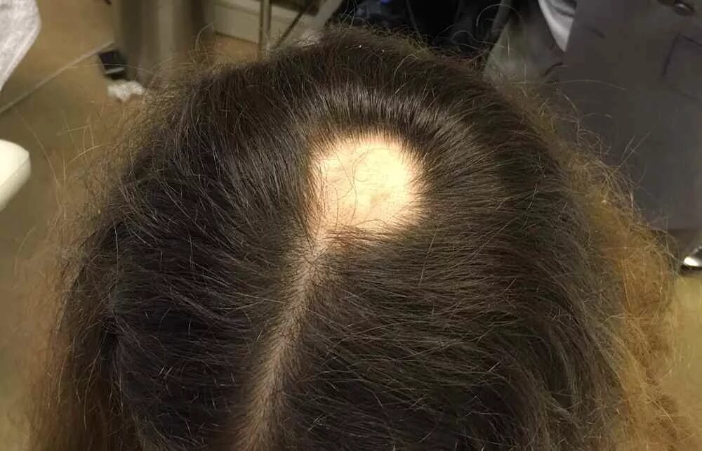 Очаговая (гнездная) алопеция. Очаговая алопеция (alopecia Areata). Хроническая телогеновая алопеция.