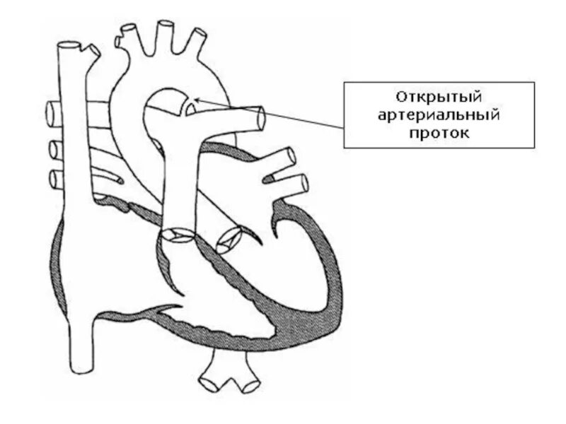 Впс открытый. Открытый артериальный проток схема. боталлов проток схема. открытый артериальный проток у новорожденных. открытый артериальный (боталлов) проток (оап.