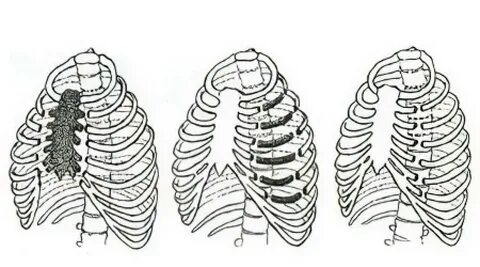 Broken ribs
